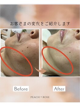 ピーチ ローズ(peach rose)/フェイスラインのもたつき