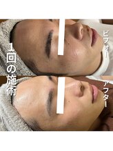 リファラ 光の森店(REFALA)/毛穴・ニキビケア専門REFALA