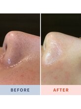 ソリス ビューティー(SOLIS BEAUTY)/毛穴洗浄