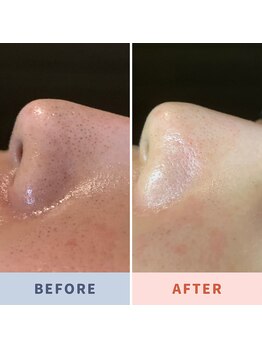 ソリス ビューティー(SOLIS BEAUTY)/毛穴洗浄