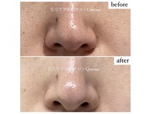 クトナ(Qutona)/開き毛穴【4か月後の変化】