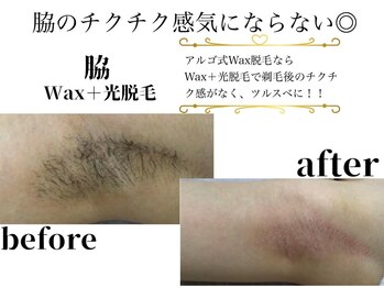 アルゴ 前橋店(ALGO)/アルゴ式WAX脱毛＋光脱毛