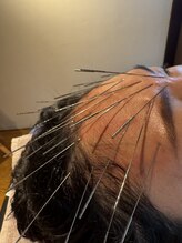 ハリドコロケン(KEN)/慢性的な頭痛も