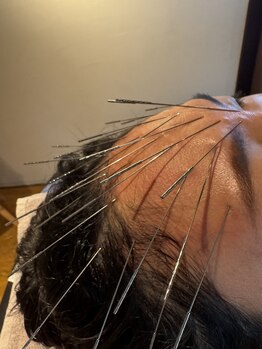 ハリドコロケン(KEN)/慢性的な頭痛も