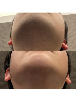 フェリーバ 流山店(FELIVA)/青髭スッキリ