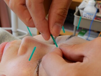 リ ムーヴ鍼灸整体院 大宮駅前院/☆美容鍼