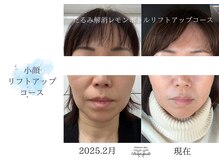 ディアスマイル(Dear.smile)/小顔リフトアップコース