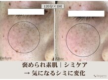 レガロビューティクリエイションズ桜川店/褒められ素肌│シミケア