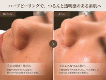 サロン カレナ(salon KARENA)の雰囲気(一回の陶肌トリートメントで毛穴がこんなに違う!!)