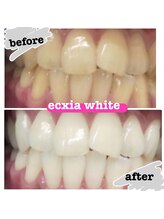 エクシアホワイトニング 日本橋店/ビフォーアフター