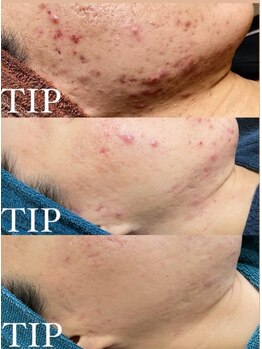 ビーピー 渋谷(b.p.)/TIPハーブピーリング