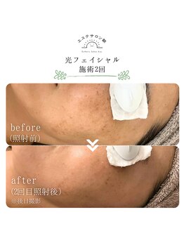 エステサロン朝/光フェイシャル