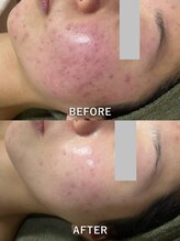 サロンドジェシカ(salon de Jessica)/ハーブピーリング＋フォト美顔