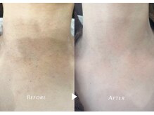 シャイニー/光フェイシャル