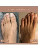 カラット(CARAT)/メンズ足の指甲脱毛