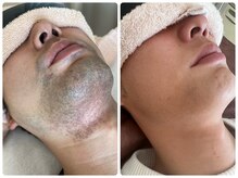 シンデレラ メンズ(Cinderella)/髭脱毛