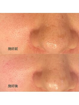 エムアンドユウ(m&u)/毛穴の変化　肌の変化