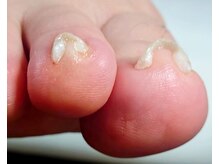 アンティ(Aunty)/コットンで爪先のくいこみ保護