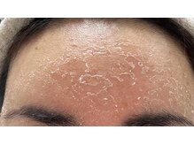 サロンハル(salon HARU)の雰囲気（剥離有りハーブピーリングでザラザラ肌・ニキビも改善）