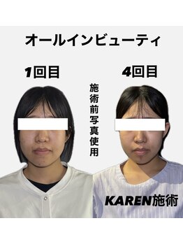 クリアランス 南青山(CLEARANCE)/施術回数4回　KAREN担当