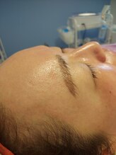 キアラ 麻布十番(Kiara)/顔脱毛おでこアフター