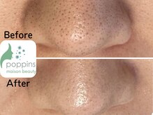 メゾンビューティーポピンズ 恵比寿(maisonbeauty poppins)/毛穴洗浄ハイドラ　メソプロ