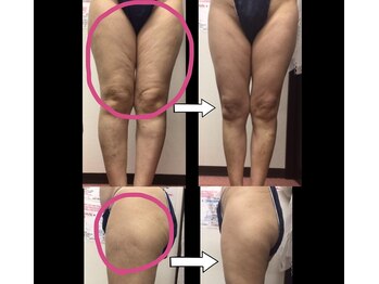 スワン 新栄店(SWAN)/凸凹脂肪改善初回Before→After 