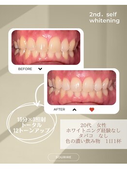 スリール(sourire)/ビフォーアフター