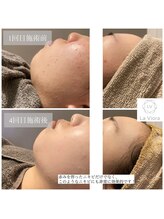 ラヴィオーラ 名駅(LaViora)/ダイヤモンドハーブピーリング