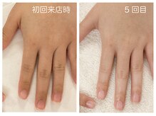 キレイテ 福岡天神店/30代/5回目【福岡ハンドケア】