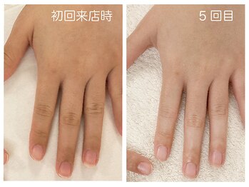 キレイテ 福岡天神店/30代/5回目【福岡ハンドケア】