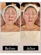 アンベリール(Embellir)/フェイス1回のビフォーアフター