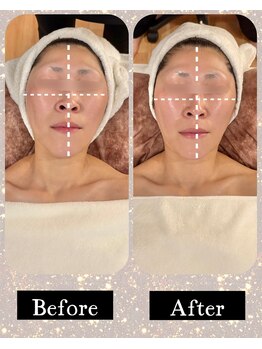 アンベリール(Embellir)/フェイス1回のビフォーアフター