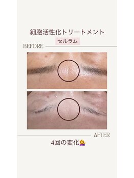 リバイセリー(Revicelly)/比較写真