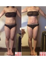 美フレッシュ 銀座店(美FRESH)/〈ハイパーナイフ施術８回効果〉