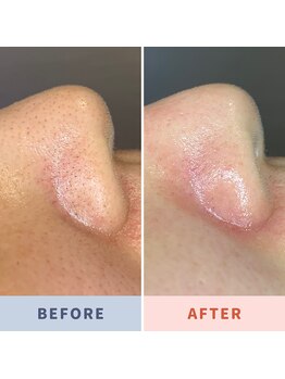 ソリス ビューティー(SOLIS BEAUTY)/毛穴洗浄