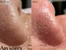 【お鼻周りの産毛もオフ◎】高濃度水素水毛穴洗浄≪小鼻≫＋鼻毛ワックス脱毛