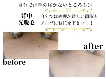 アルゴ 前橋店(ALGO)/ コース開始前→コース１０回