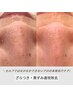 【毛穴洗浄/毛穴引き締め】毛穴洗浄+光フェイシャル　13000円→11000円