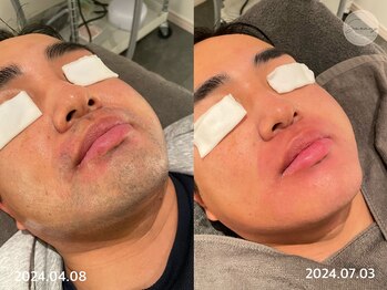 サラン(Sarang)/ヒゲ脱毛before after