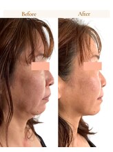 ルルドフォンテ(rurudo fonte.)/フェイスラインのもたつき解消