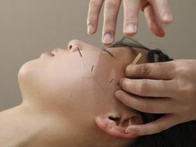 ラビィ(lovie)/美容鍼