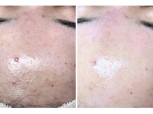 エヌエクラ(N.eclat.)/おでこも一発