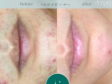 スキンラボアメリ(skin lab. ameri)/お悩み…ニキビごわつき