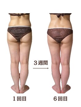 ラニカイ 八代店(Lanikai)/痩身エステ　30代のお客様