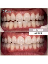 イージーホワイトニング 五反田店(easy whitening)/セルフホワイトニング症例写真