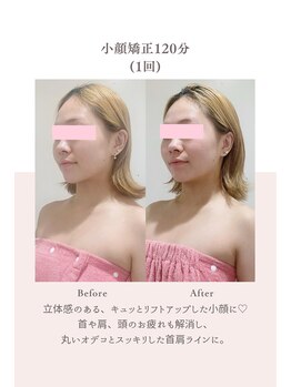 トゥインクル 麻布(twinkle)/麻布十番/シンメトリー小顔矯正