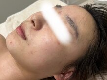 ビューティーサロン アンド ユー シブヤ(Beauty Salon&U Shibuya)/クリスティーナ施術2回後