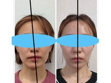 パルフェ(THE Parfait)/美容整骨【小顔矯正】