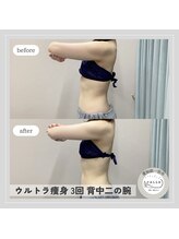 カラー(CALLA)/痩せにくい二の腕もこの通り！